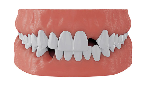 estrada-implants-1-2